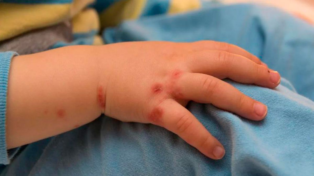 Reportan 3 casos de sarampión en Tabasco