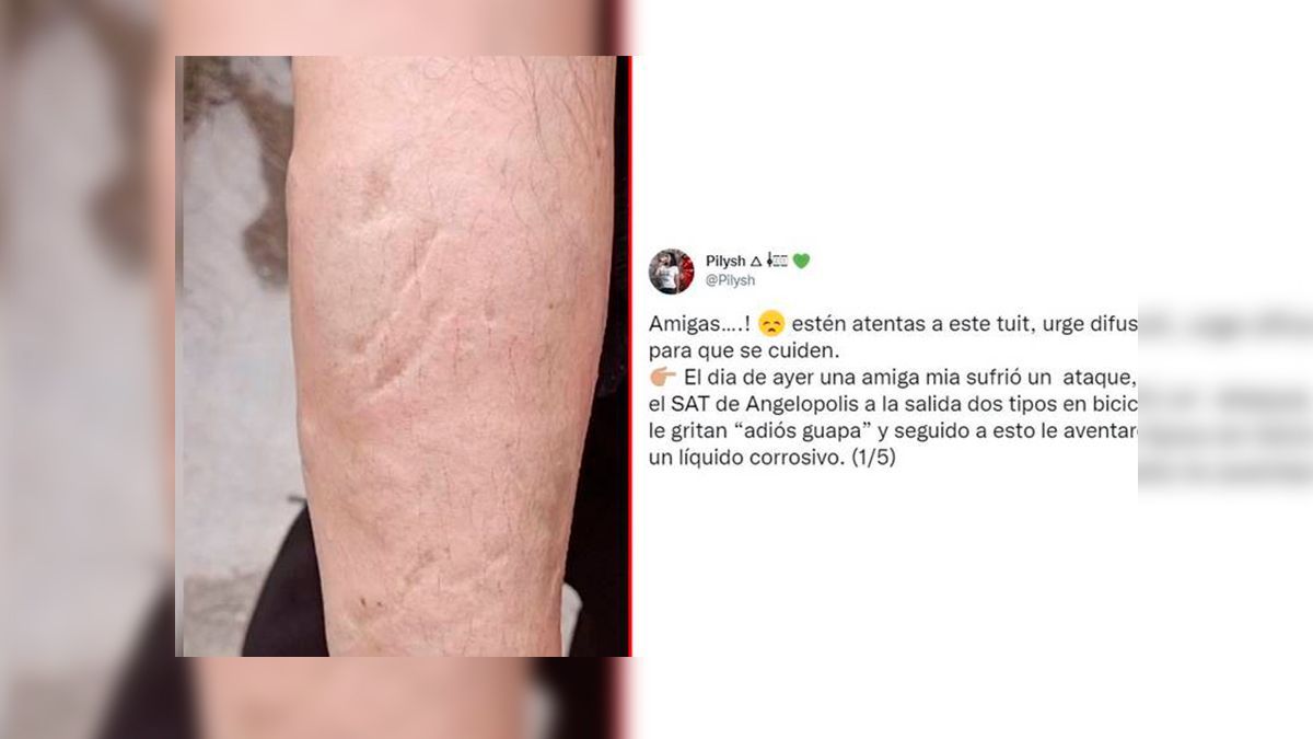 Atacan con ácido a una mujer en Puebla