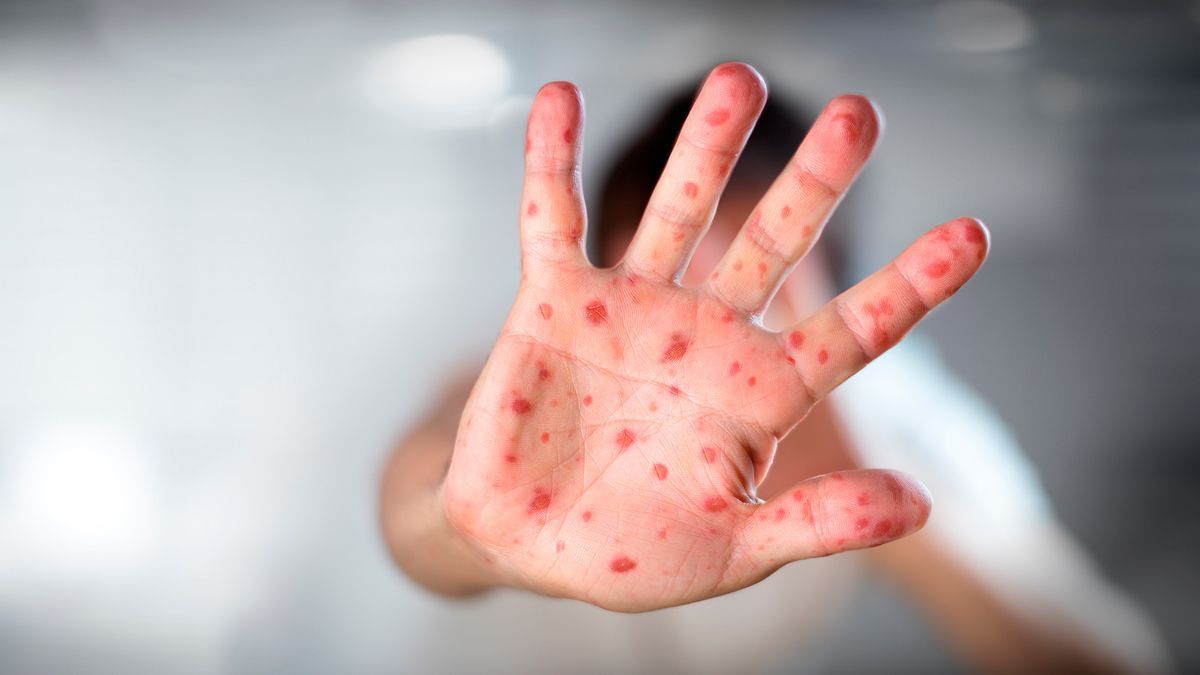 Por viruela del mono emiten aviso epidemiológico en México