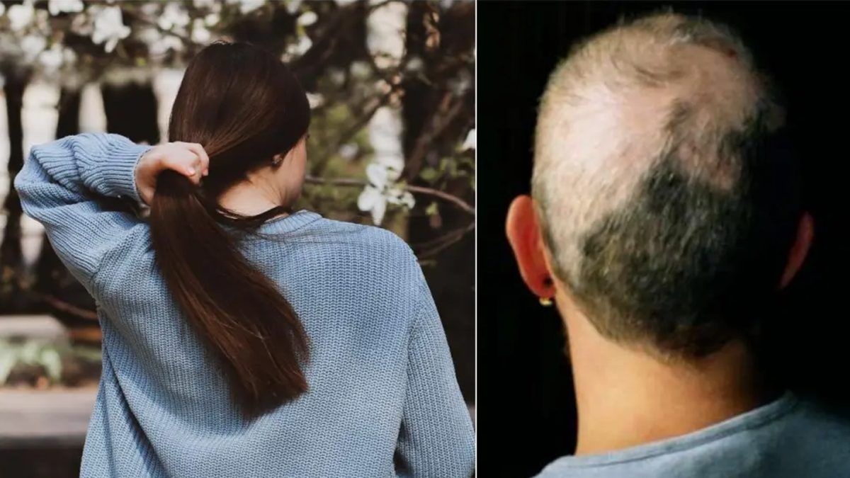 Aprueba la FDA primer tratamiento contra la alopecia