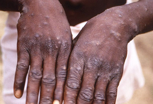 Qué es la viruela del mono? La enfermedad que ya se detectó en América |  Tec Review