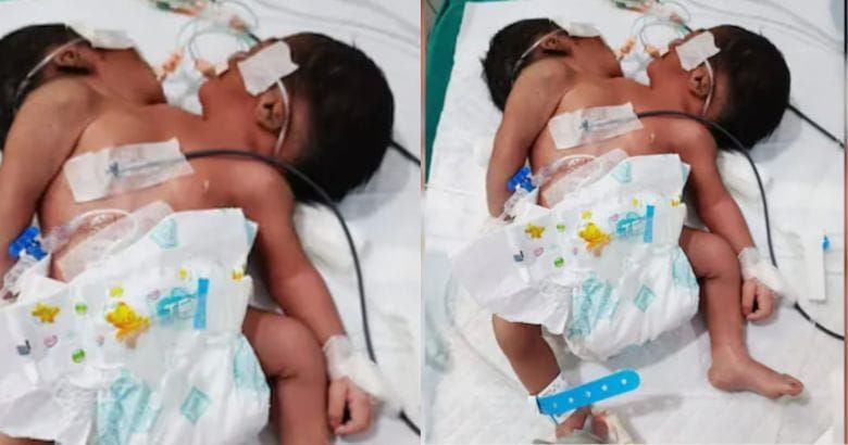 രണ്ട് തലകളും ഒരു ശരീരവും; വൈദ്യലോകത്തെ അമ്പരപ്പിച്ച് അപൂർവ ജനനം; കുഞ്ഞ് വിദഗ്ധ നിരീക്ഷണത്തിൽ