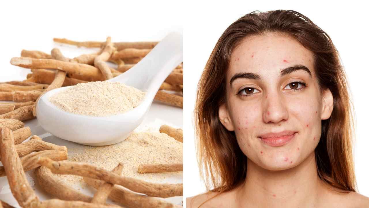 Can Ashwagandha Cause Acne