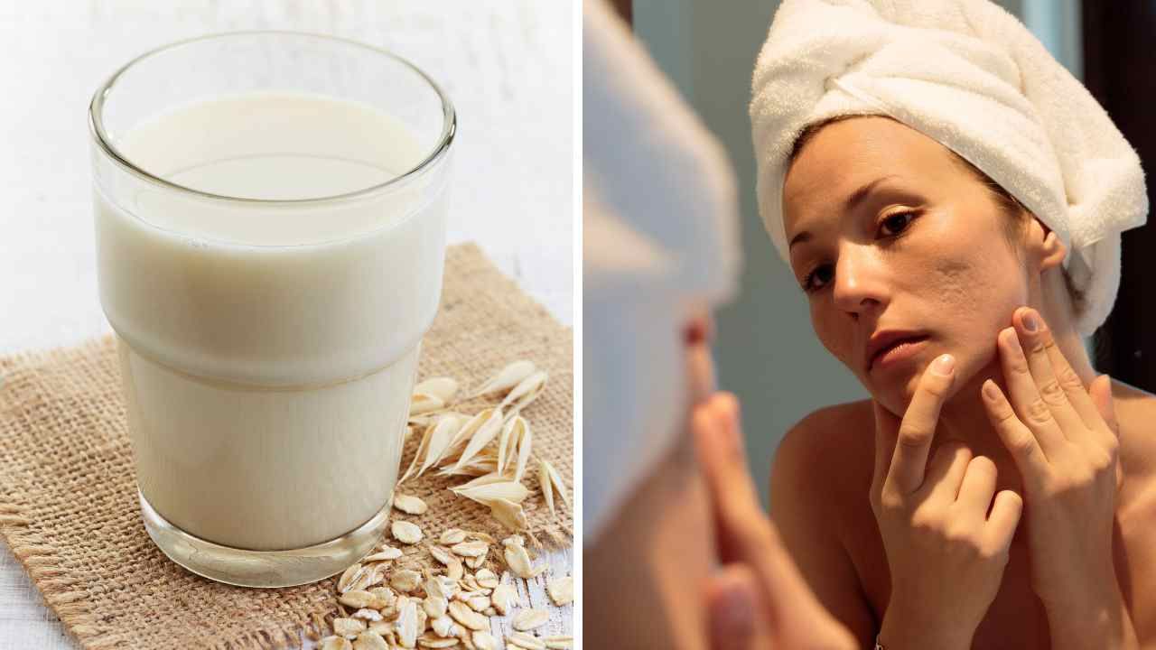 Can Oat Milk Cause Acne