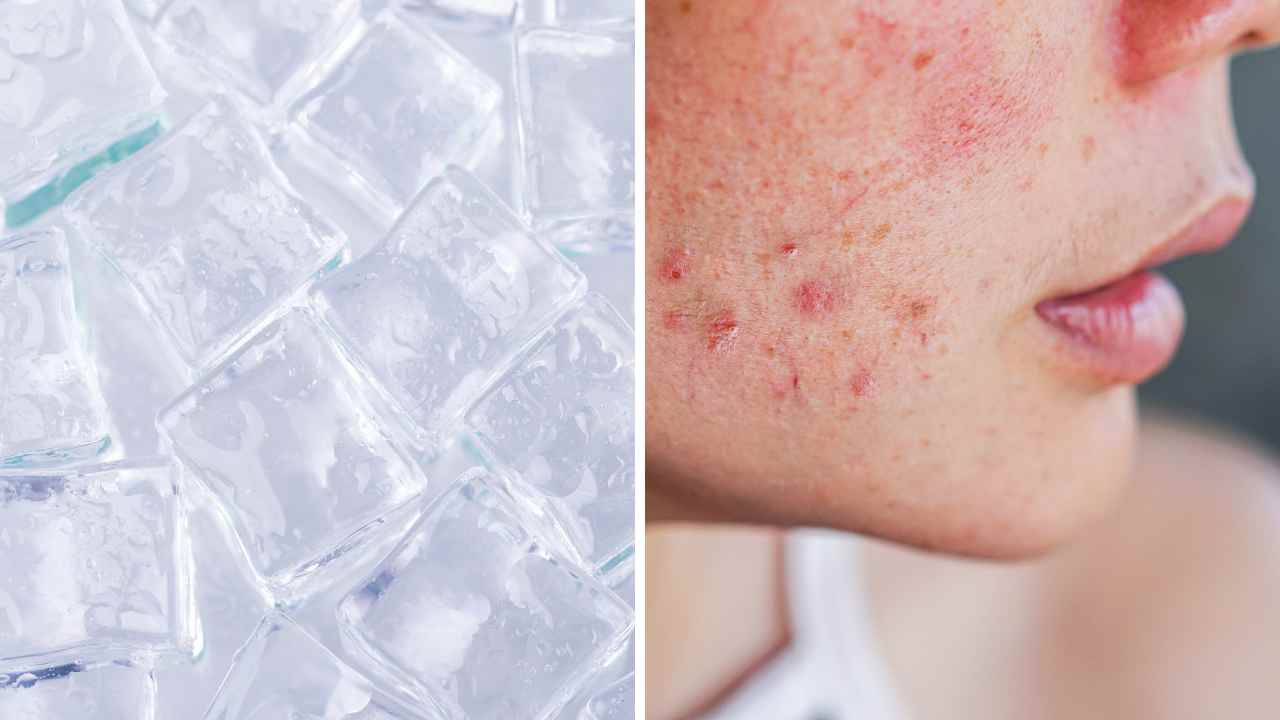 Does Ice Help Acne