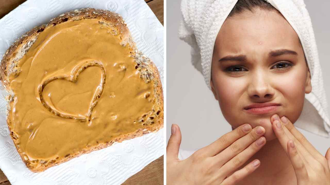 Does Peanut Butter Cause Acne