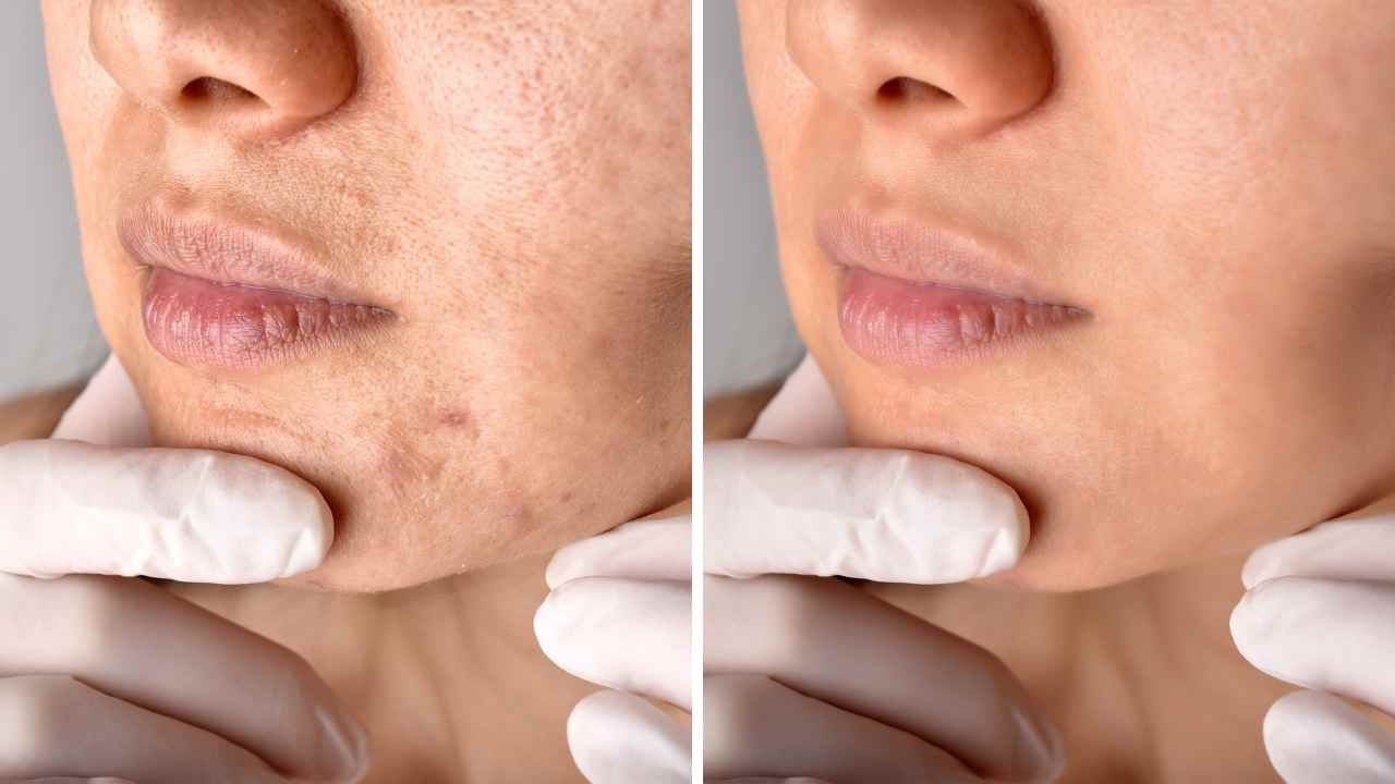 Does Tretinoin Help with Acne Scars