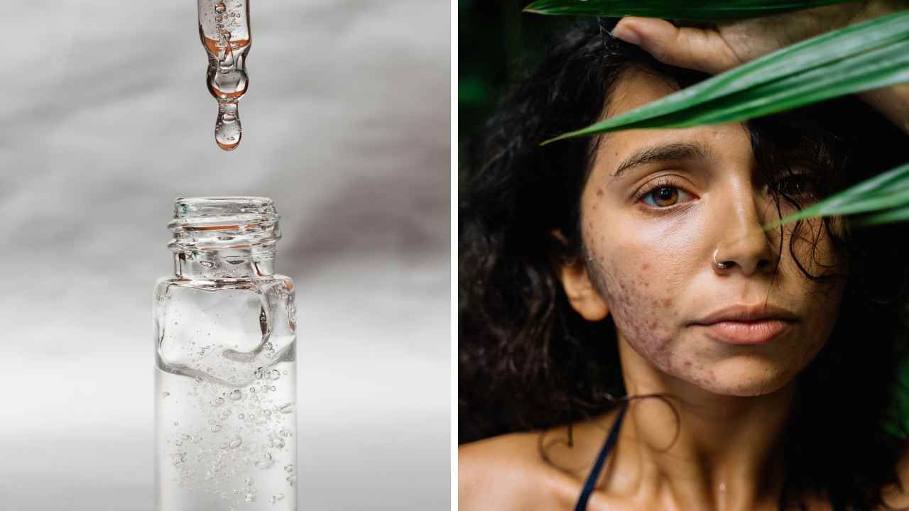 Is Hyaluronic Acid Good for Acne