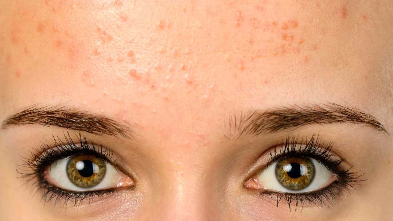 how to get rid of forehead acne