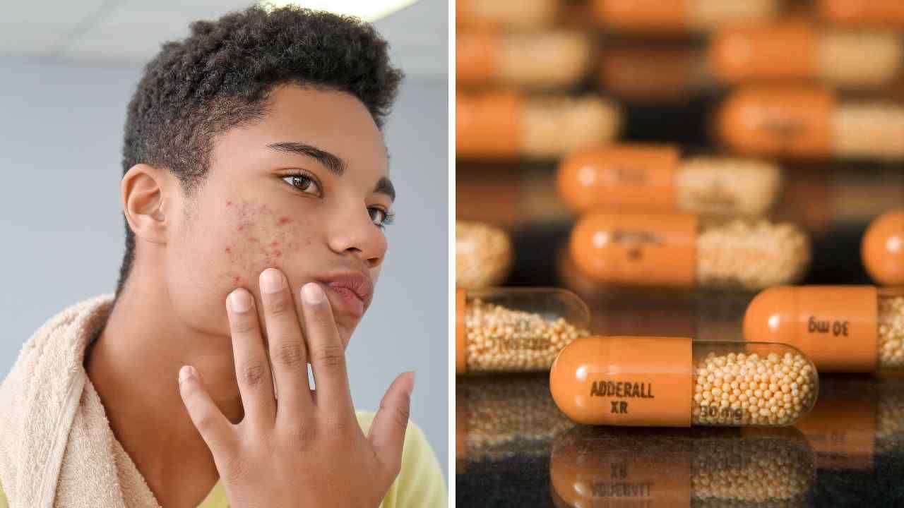 Does Adderall Cause Acne