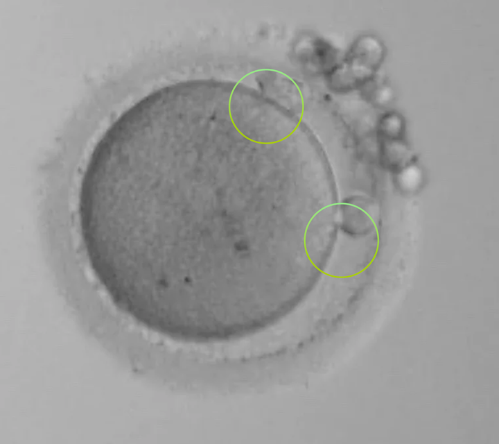  A 0PN atypically fertilised embryo