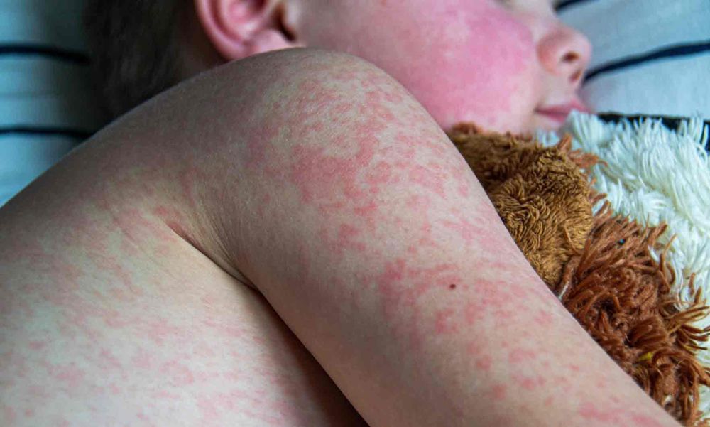 Public health lists exposure sites as measles cases continue to rise post image
