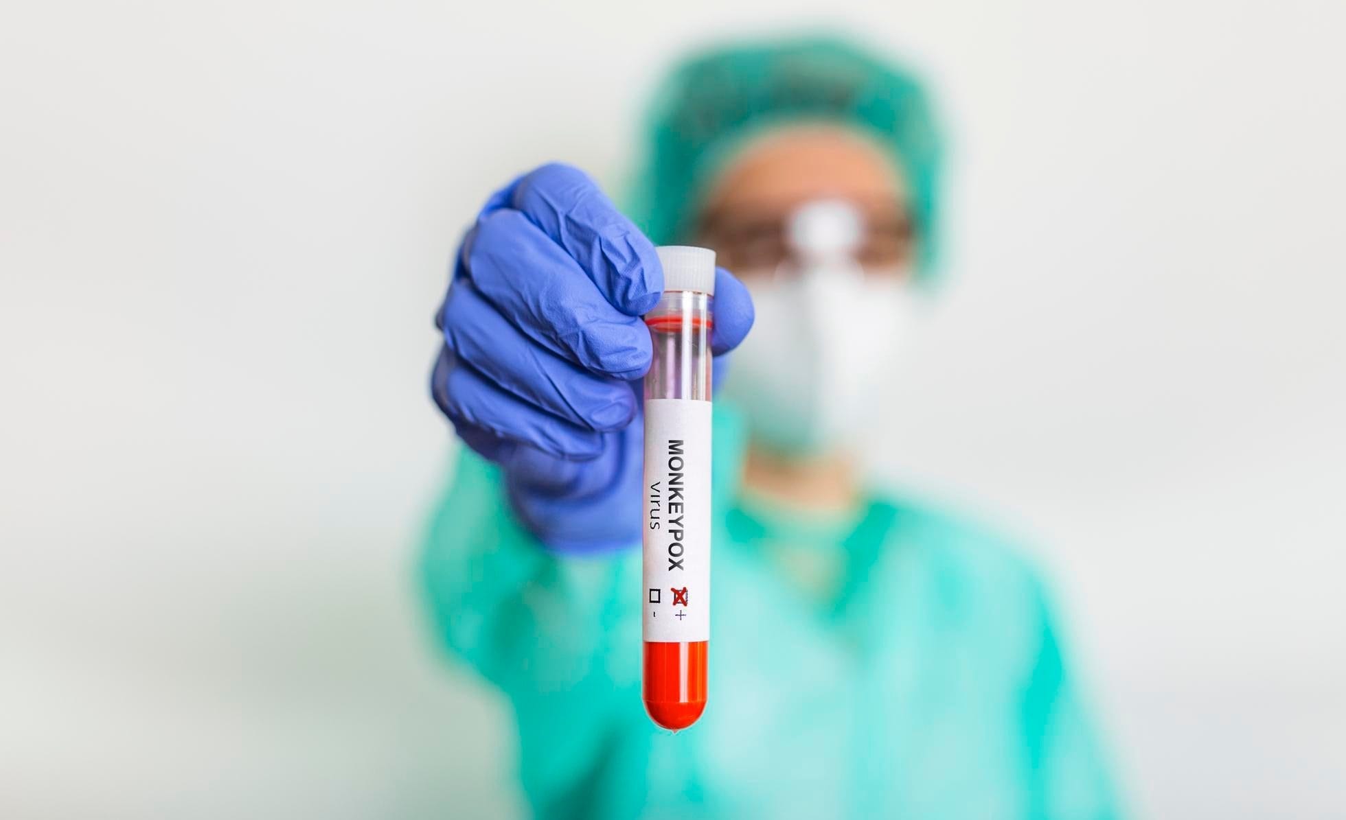 Second case of monkeypox confirmed in Wellington County