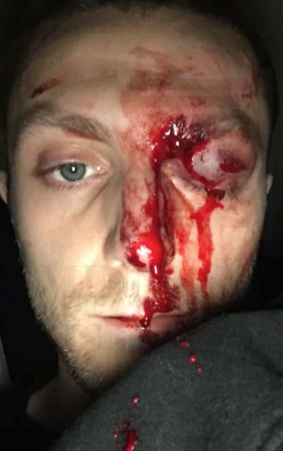 Minnesota cop injured man’s eye with riot munition, lawsuit says