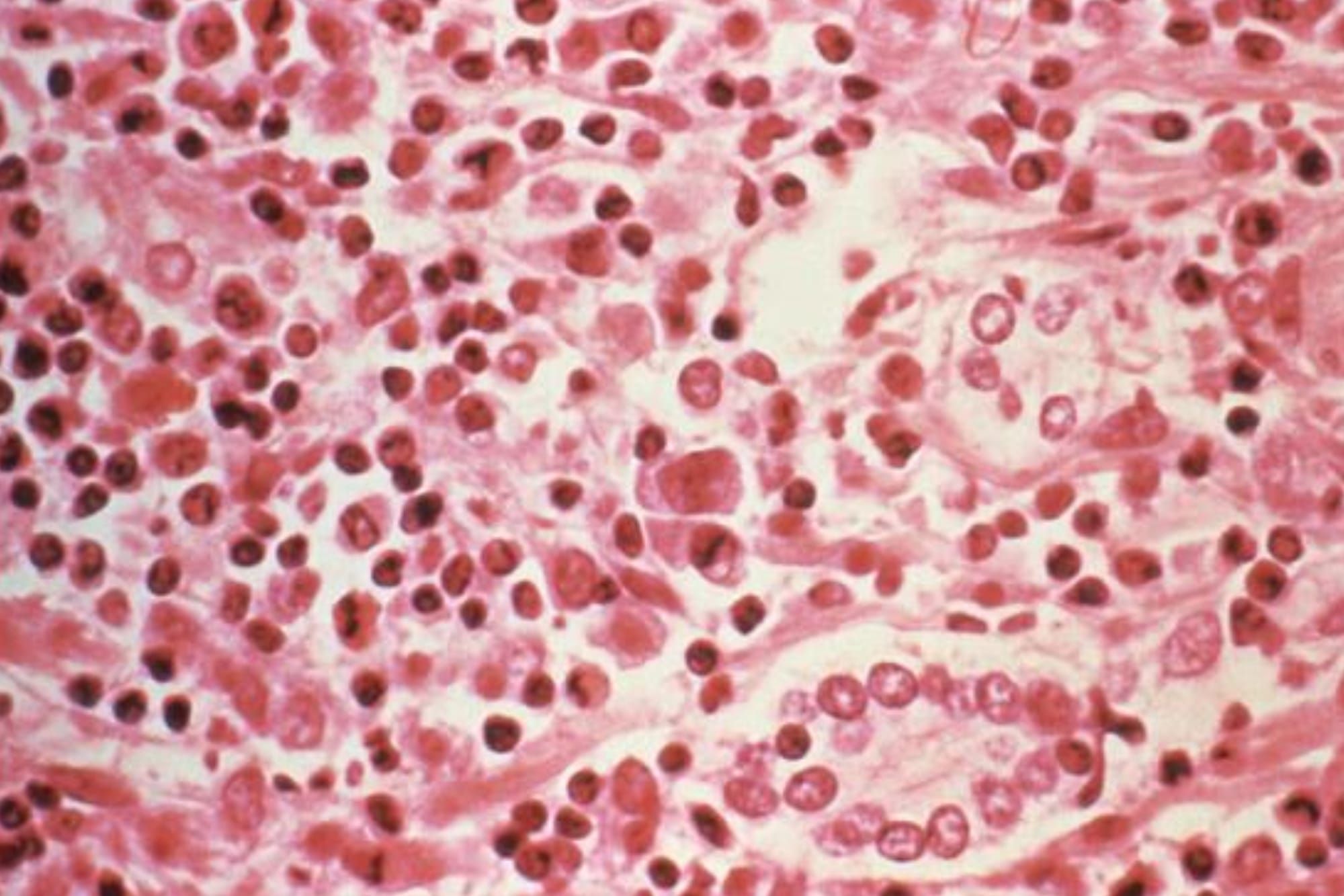 Cruise ship Hantavirus outbreak poses little risk to wider public