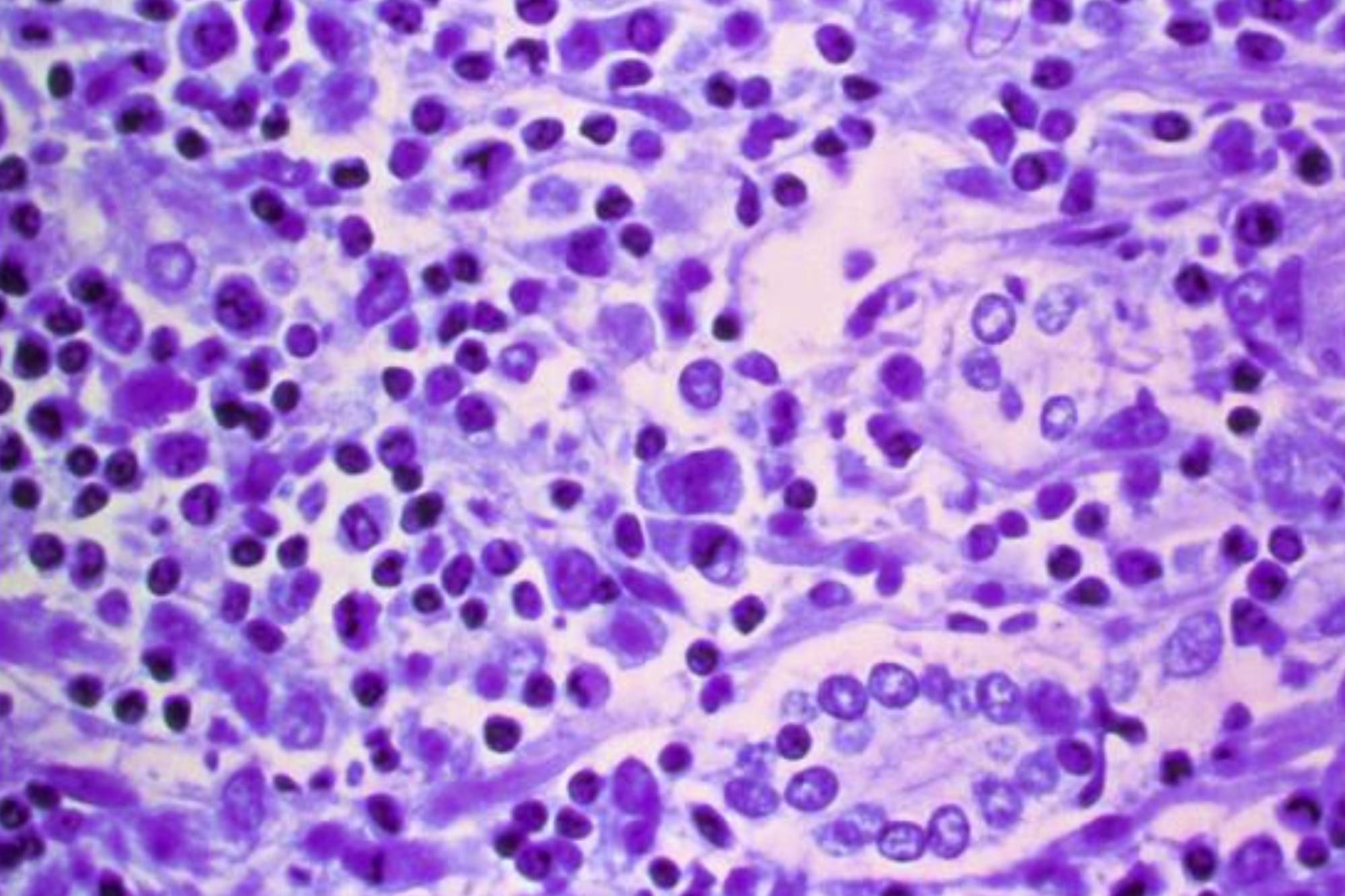 Hantavirus confirmed as rare human-to-human variant