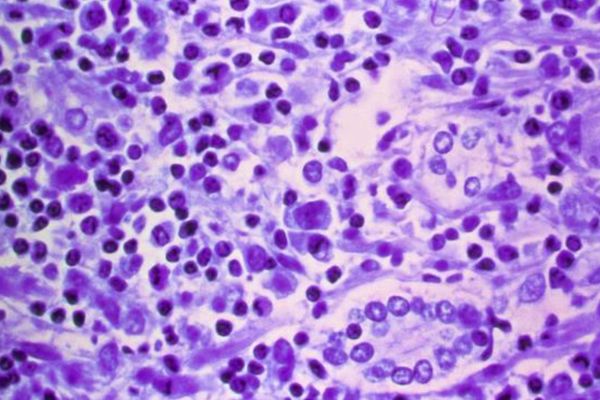 Hantavirus confirmed as rare human-to-human variant