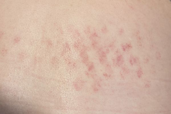 Red Grid Mark Phenomenon: My Experience