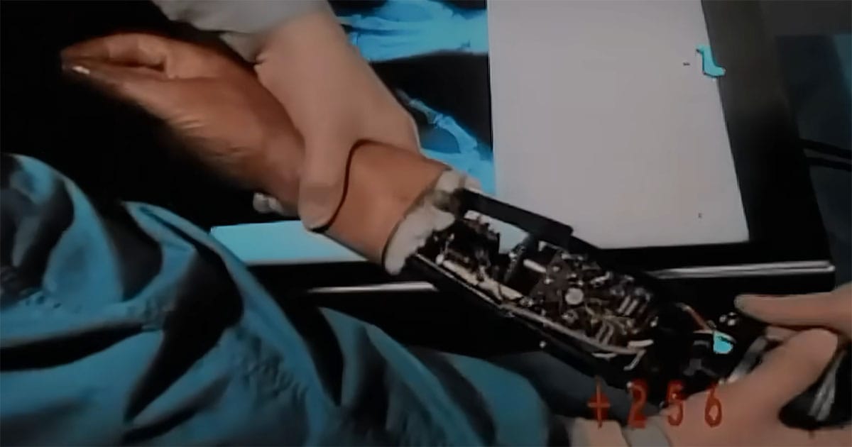 Close-up of Steve Austin’s bionic arm with visible mechanical components during surgery