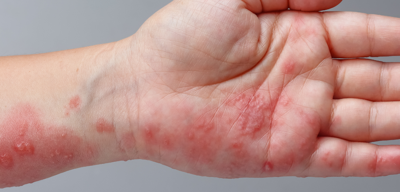 ‘Take it from me, get the shingles vaccine if you can'