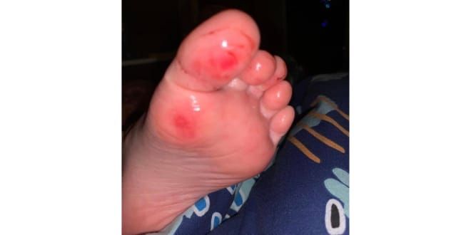 ‘Cuts and grazes’ at new Mirboo North pool post image