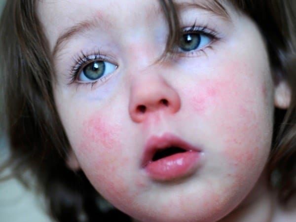 O que é escarlatina pela Germânica Heilkunde?