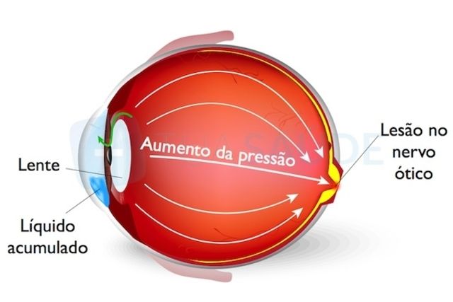 Como ajudar uma pessoa com Glaucoma