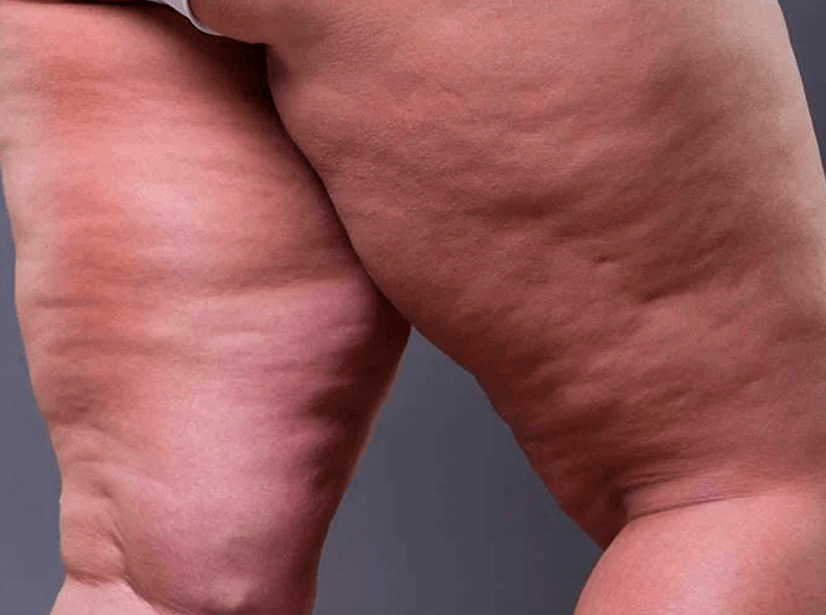 Celulite: Como eliminá-la segundo a Medicina Germânica