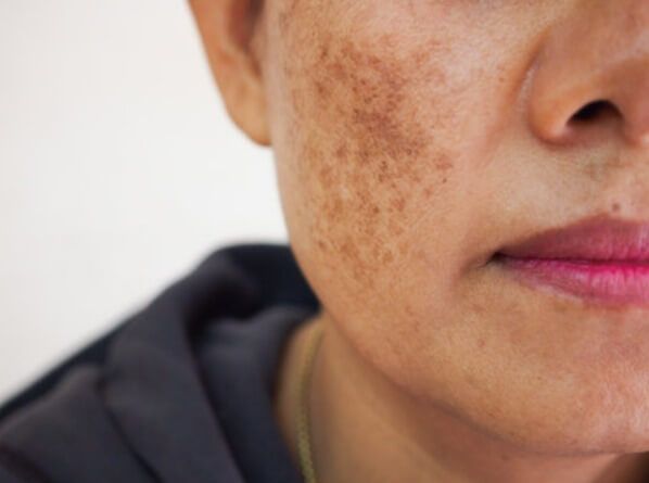 Melasma: A Real Causa segundo a Medicina Germânica