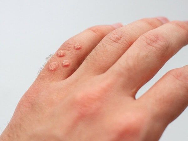 Verrugas na pela pela Medicina Germânica