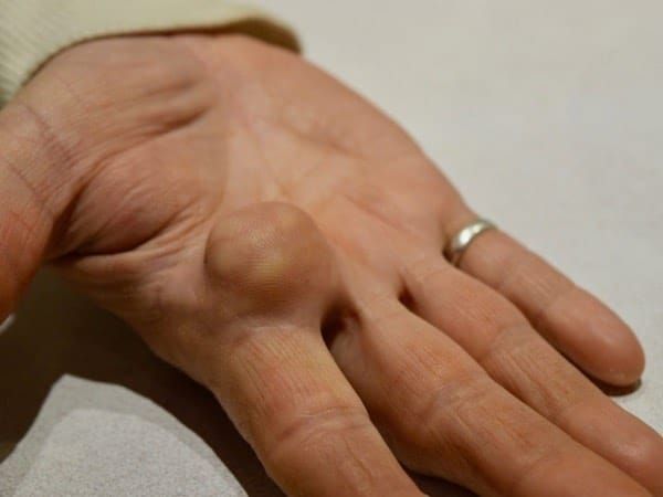 O que é lipoma? Pela Germânica Heilkunde