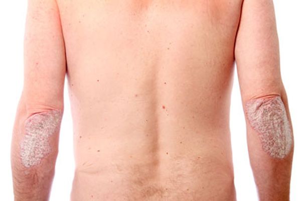 Como Tomar Controle de Uma Vez Por Todas do Sua Psoríase