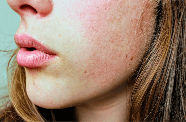 Lupus e a Germanica Heilkunde