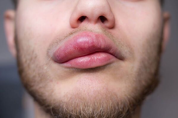 O que pode causar angioedema? Pela Medicina Germânica Heilkunde