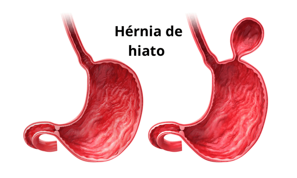 O que é hérnia de hiato? Pela Germânica Heilkunde