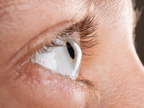 O que é o Ceratocone? Pela Germânica Heilkunde