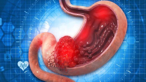 O que é úlcera péptica? Pela Germânica Heilkunde