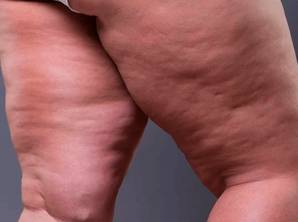 Celulite: Como eliminá-la segundo a Medicina Germânica