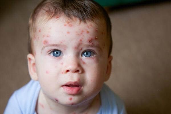 Catapora segundo a Germânica Heilkunde