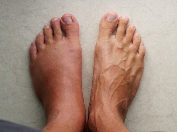 Atrofia de Sudeck pela Germânica Heilkunde