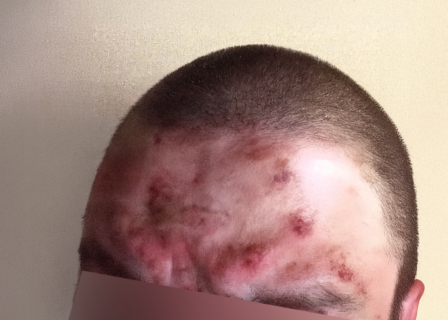 Gros plan sur le front et le haut du crâne d’une personne à la peau claire et aux cheveux très courts. Le front présente une inflammation cutanée étendue, marquée par de nombreuses rougeurs et lésions.