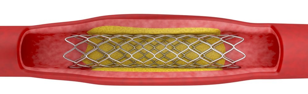 Biomaterials - angioplasty with stent placement