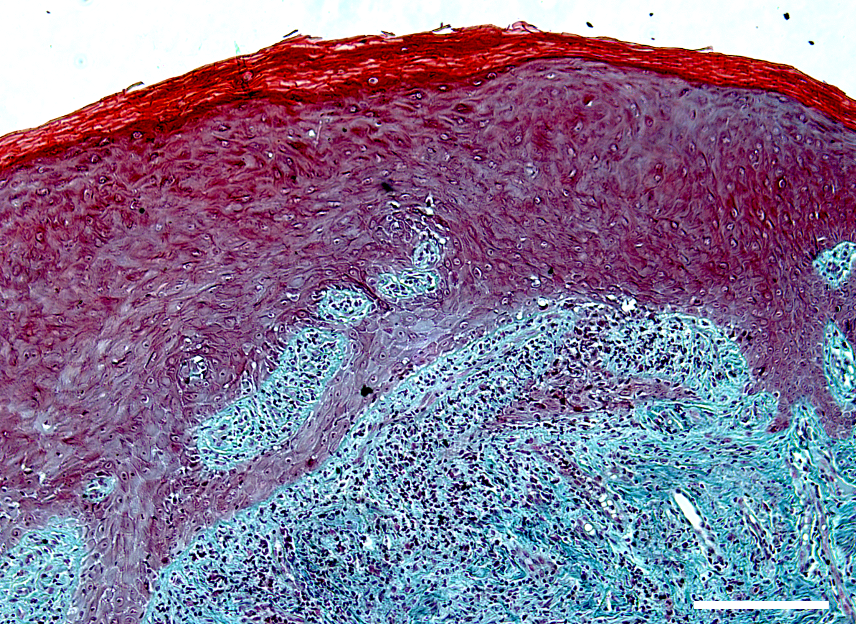 An overview of drug-induced gingival enlargement
