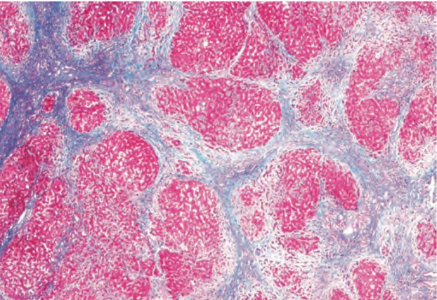 An overview of cirrhosis