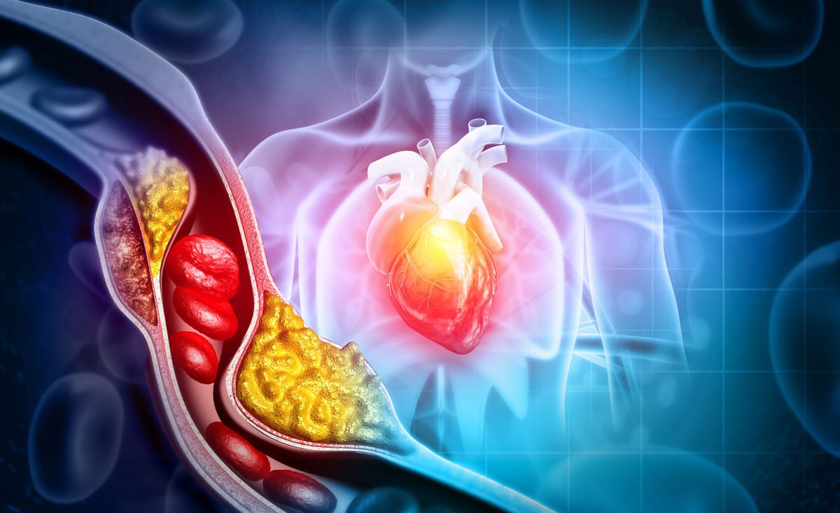 What seniors should know about cholesterol and heart disease