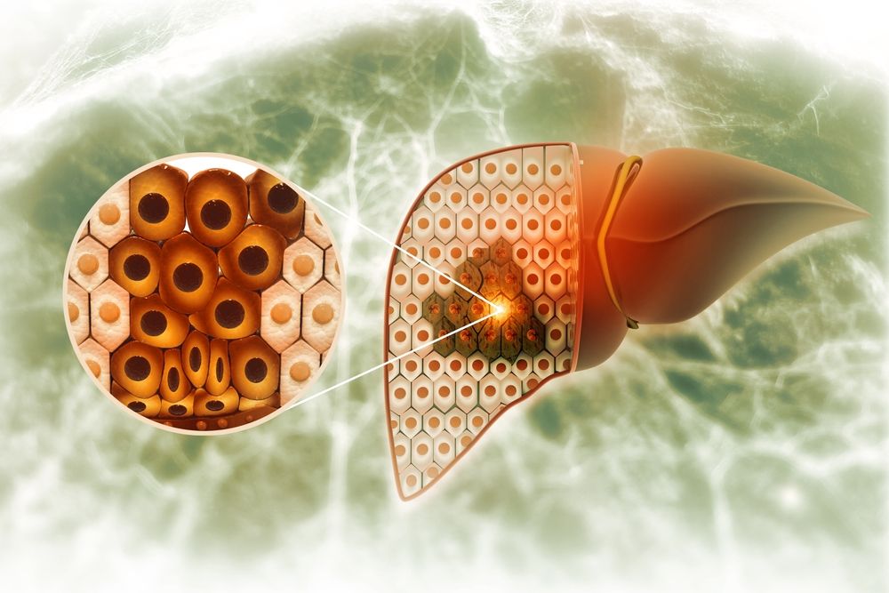 An overview of steatohepatitis