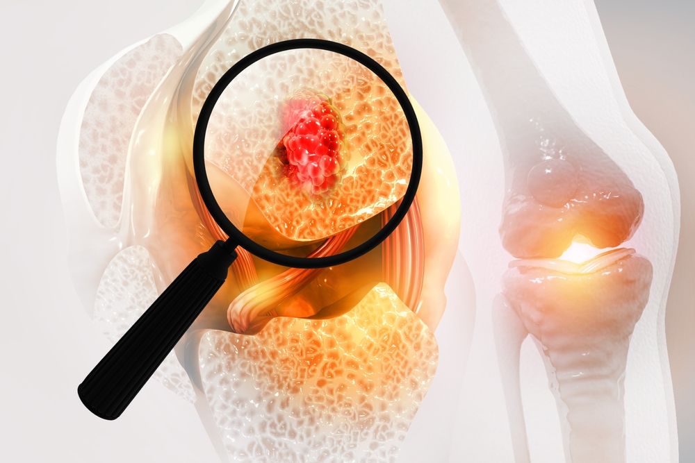 An overview of osteosarcoma