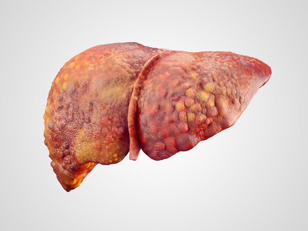 Age-related diseases: cirrhosis