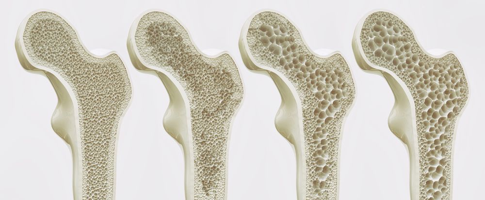 Ways seniors can prevent osteoporosis