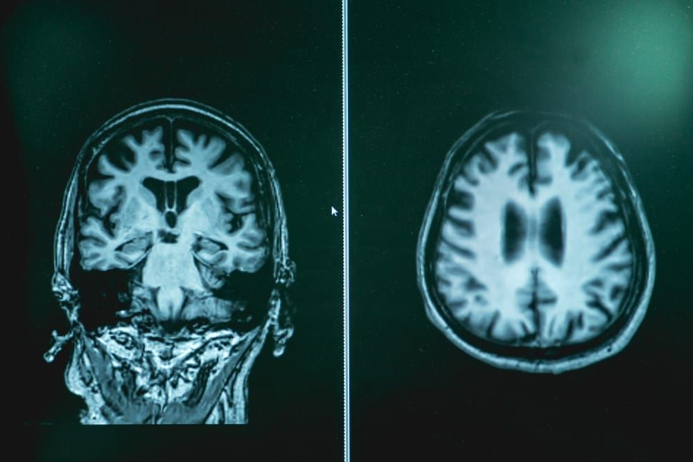 How Alzheimer’s disease develops over time